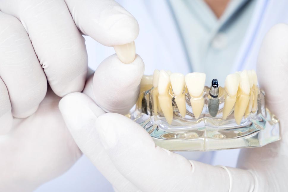 Implante dental